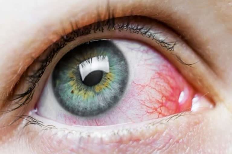 उत्तराखंड : उत्तराखंड में काले फंगस का प्रकोप, अब तक 9 मरीजों की मौत