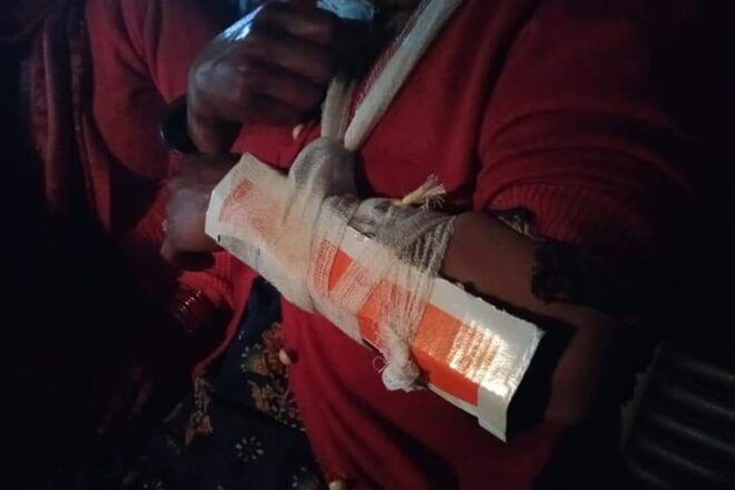 पौड़ी : महिला का हाथ "फ्रैक्चर" हो गया था, इसलिए डॉक्टर ने प्लास्टर को "गत्ता" से बदल दिया.